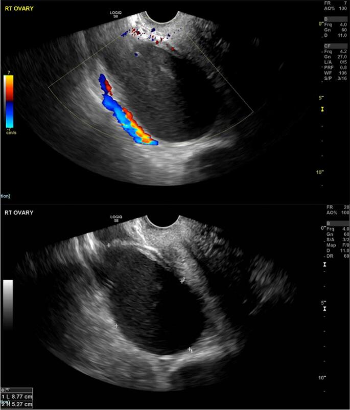 Tubo-ovarian abscess after vaginal delivery: A case report and review of current literature