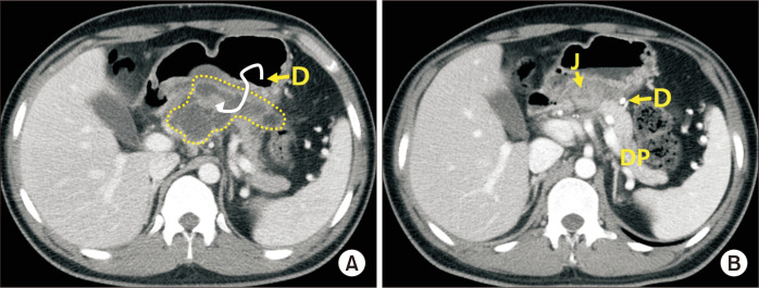 Robotic central pancreatectomy: a surgical technique.