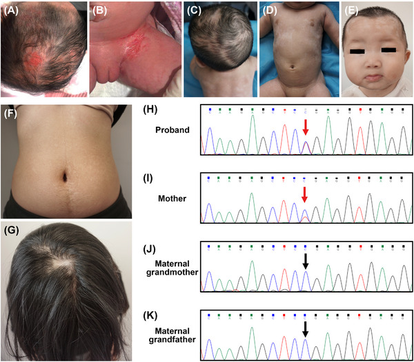 A case of familial incontinentia pigmenti in infancy without hyperpigmented stage.