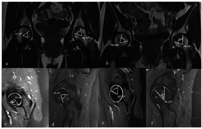 Core decompression combined with local DFO administration loaded on polylactic glycolic acid scaffolds for the treatment of osteonecrosis of the femoral head: a pilot study.