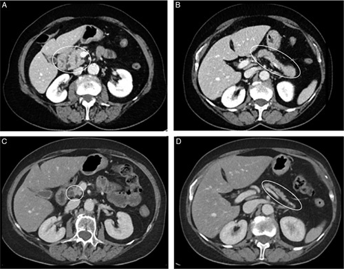 Immune Checkpoint Inhibitor-related Pancreatitis: A Case Series, Review of the Literature and an Expert Opinion.