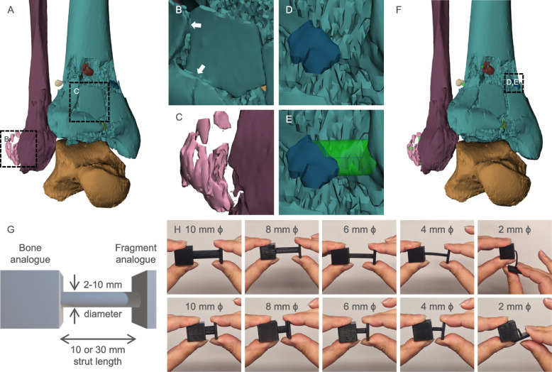 Technical improvements in preparing 3D printed anatomical models for comminuted fracture preoperative planning.