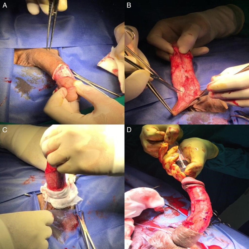 Isolated ventral congenital penile curvature treated by incisionless plication of tunica albuginea in adults: A prospective case series.