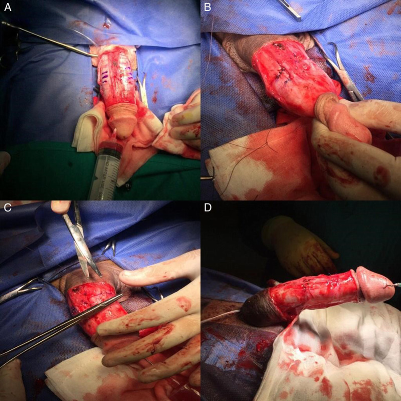 Isolated ventral congenital penile curvature treated by incisionless plication of tunica albuginea in adults: A prospective case series.