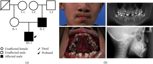 Identification of a Novel Variant of <i>PDGFC</i> Associated with Nonsyndromic Cleft Lip and Palate in a Chinese Family.