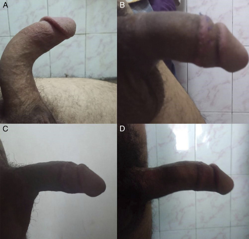 Isolated ventral congenital penile curvature treated by incisionless plication of tunica albuginea in adults: A prospective case series.