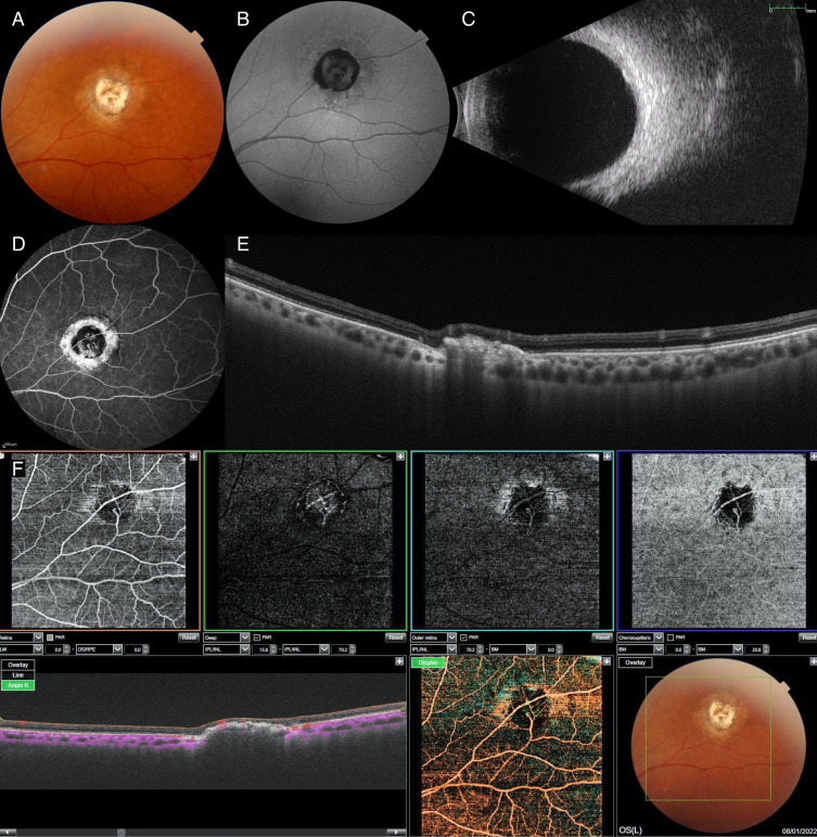 Diagnosis and Management Strategies in Sclerochoroidal Calcification: A Systematic Review.