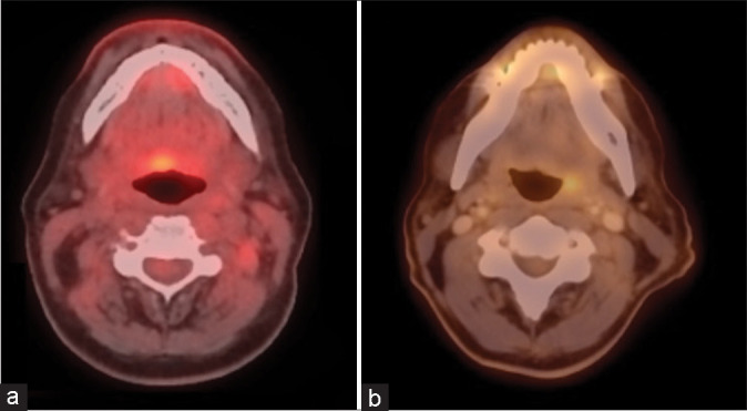 Post-treatment PET/CT for p16-positive oropharynx cancer treated with definitive proton therapy.