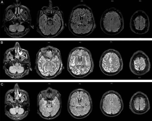 Systemic Neoplastic Cryoglobulinemic Vasculitis Mimics Large Vessel Occlusion: A Case Report.