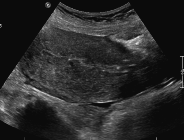 A one-step conservative surgical approach to undiagnosed focal accreta: A case report