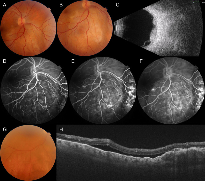 Diagnosis and Management Strategies in Sclerochoroidal Calcification: A Systematic Review.