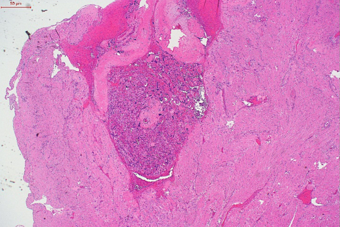 A one-step conservative surgical approach to undiagnosed focal accreta: A case report