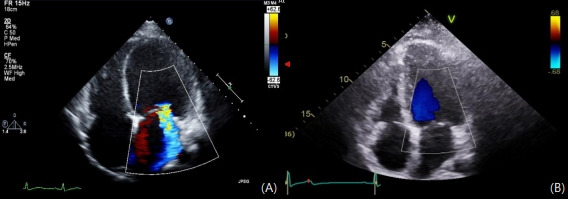 Combination therapy of liothyronine and levothyroxine for hypothyroidism-induced dilated cardiomyopathy.