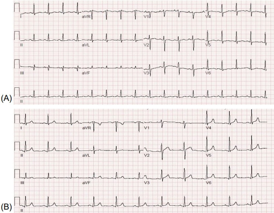 Combination therapy of liothyronine and levothyroxine for hypothyroidism-induced dilated cardiomyopathy.