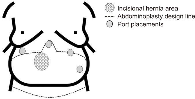 Robot-assisted kidney transplantation in a morbidly obese patient with incisional hernia reconstruction and abdominoplasty: a case report.