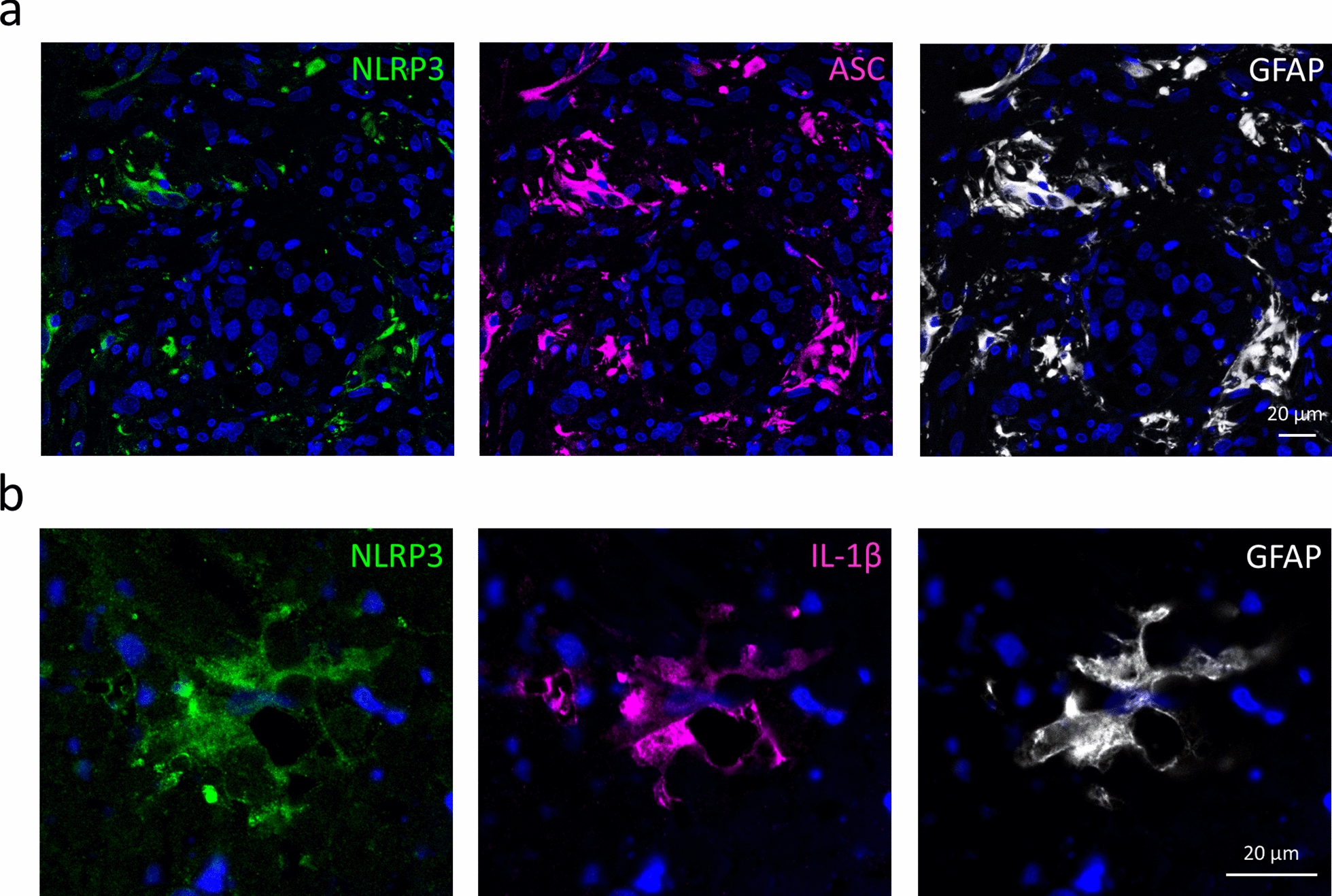 Inflammasome activation in peritumoral astrocytes is a key player in breast cancer brain metastasis development.