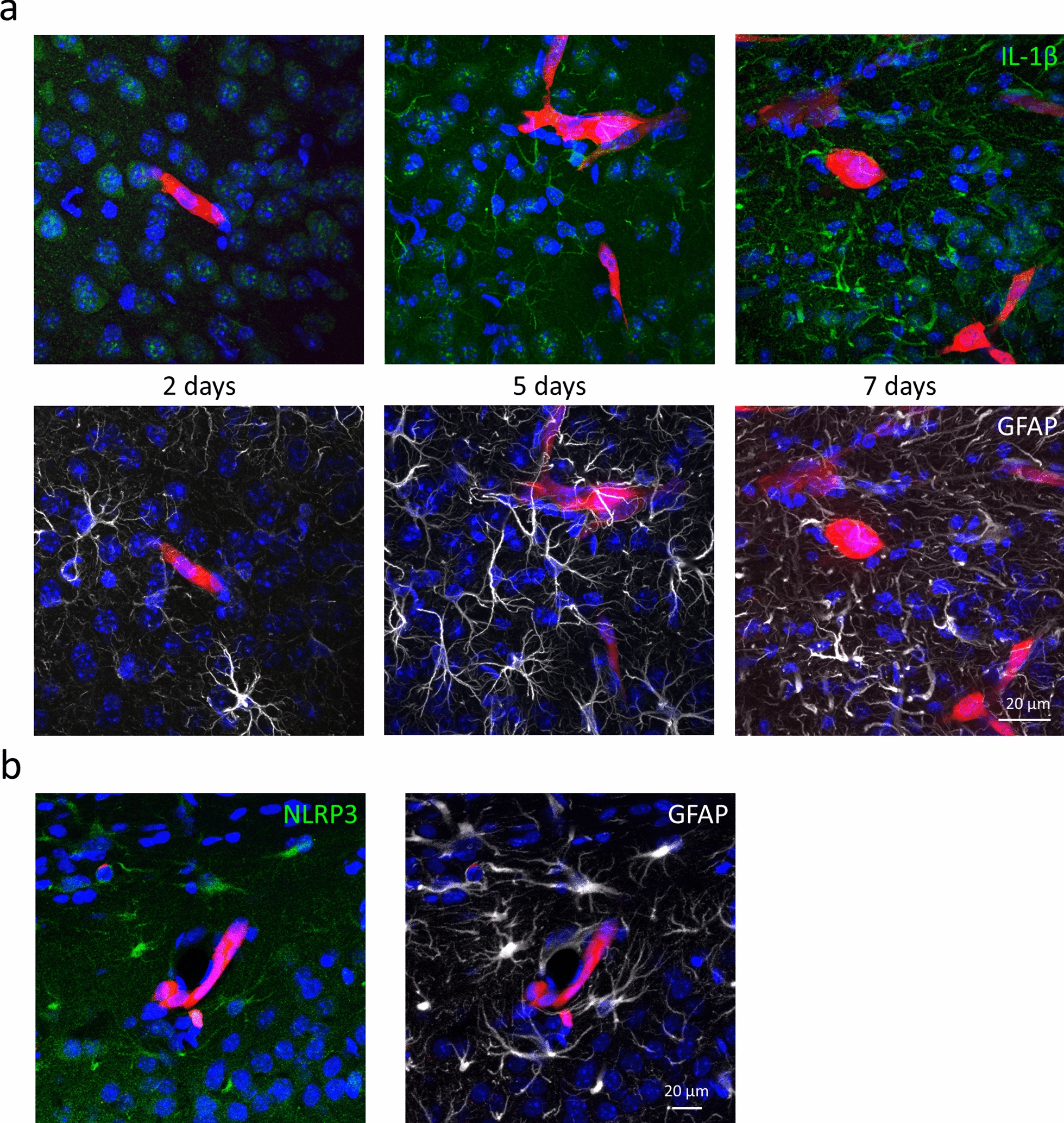 Inflammasome activation in peritumoral astrocytes is a key player in breast cancer brain metastasis development.