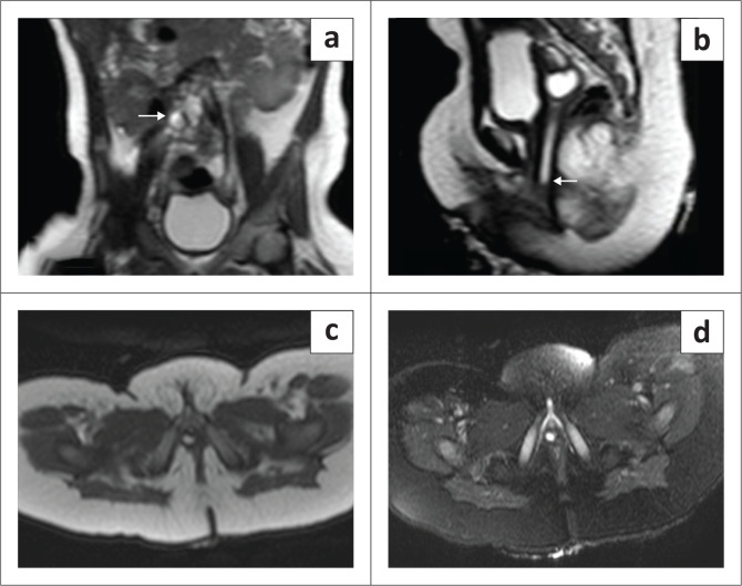 Ipsilateral renal dysgenesis or agenesis with tubulocystic anomalies of the mesonephric duct.