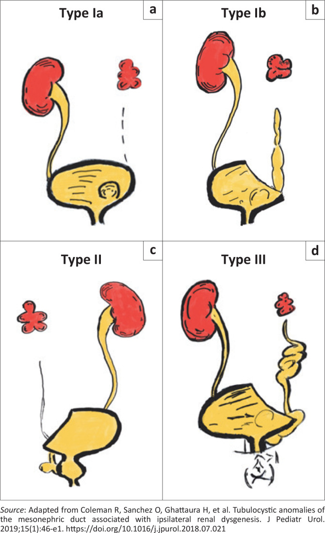 Ipsilateral renal dysgenesis or agenesis with tubulocystic anomalies of the mesonephric duct.