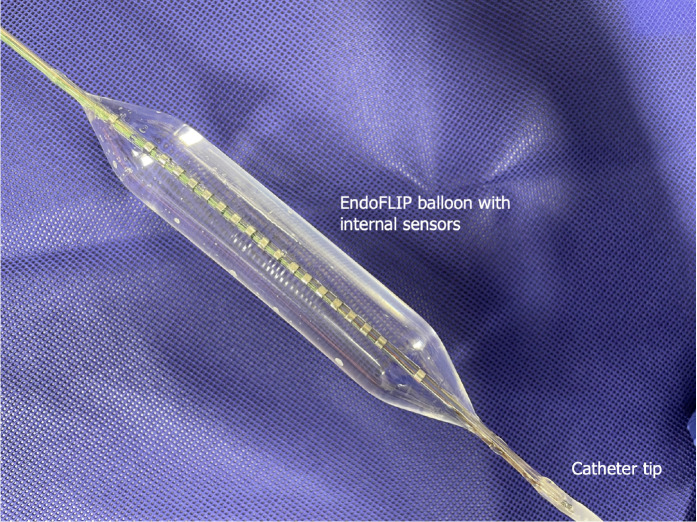 Use of endolumenal functional lumen imaging probe in investigating paediatric gastrointestinal motility disorders.