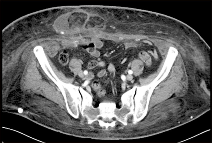 Robot-assisted kidney transplantation in a morbidly obese patient with incisional hernia reconstruction and abdominoplasty: a case report.