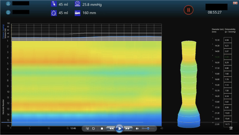 Use of endolumenal functional lumen imaging probe in investigating paediatric gastrointestinal motility disorders.