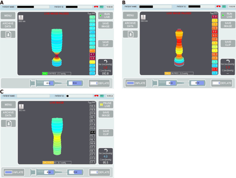 Use of endolumenal functional lumen imaging probe in investigating paediatric gastrointestinal motility disorders.