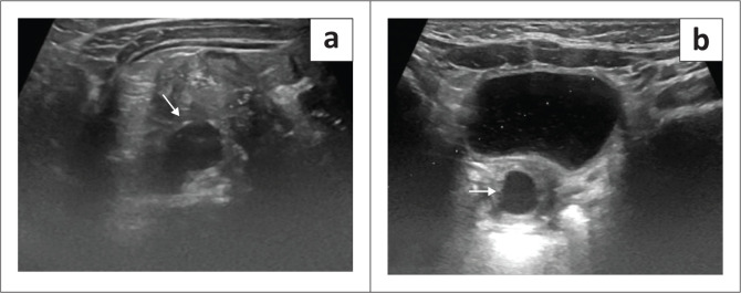 Ipsilateral renal dysgenesis or agenesis with tubulocystic anomalies of the mesonephric duct.