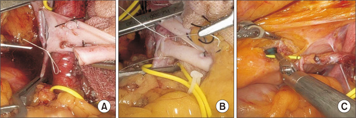 Robot-assisted kidney transplantation in a morbidly obese patient with incisional hernia reconstruction and abdominoplasty: a case report.