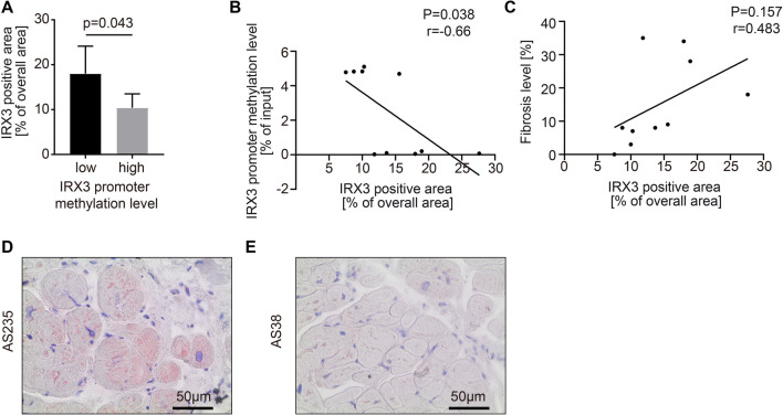 Low levels of circulating methylated IRX3 are related to worse outcome after transcatheter aortic valve implantation in patients with severe aortic stenosis.