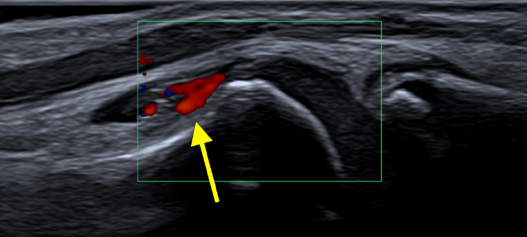 Ultrasound and MRI of the foot in children and adolescents newly diagnosed with juvenile idiopathic arthritis.