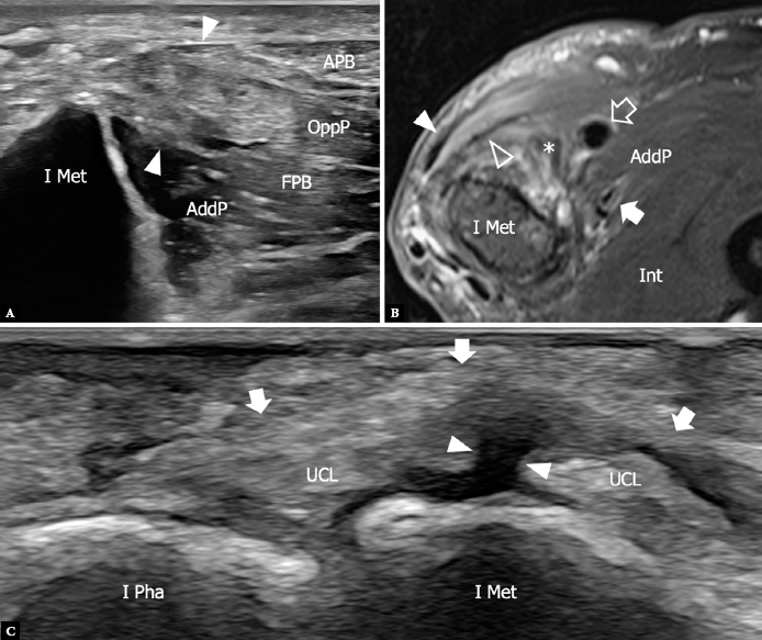 Ultrasound of the palmar aspect of the hand: normal anatomy and clinical applications of intrinsic muscles imaging.