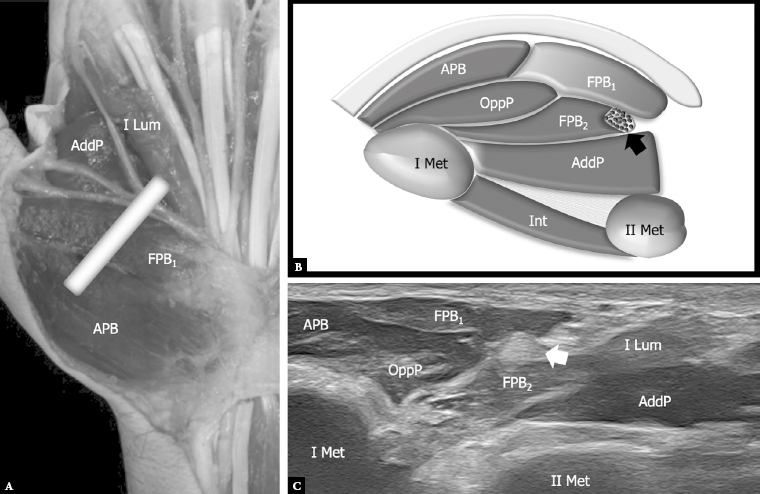 Ultrasound of the palmar aspect of the hand: normal anatomy and clinical applications of intrinsic muscles imaging.