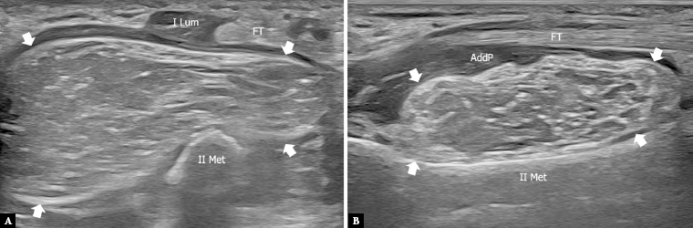 Ultrasound of the palmar aspect of the hand: normal anatomy and clinical applications of intrinsic muscles imaging.