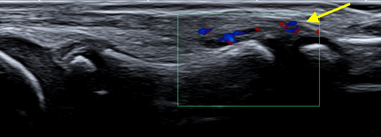 Ultrasound and MRI of the foot in children and adolescents newly diagnosed with juvenile idiopathic arthritis.