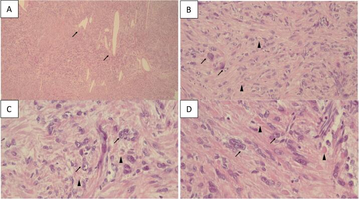 Hereditary leiomyomatosis and renal cell cancer (HLRCC) syndrome in a young patient presenting with a large uterus: A case report and review of the literature