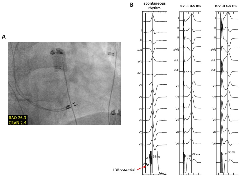 Left ventricular septal pacing – can we trust the ECG?