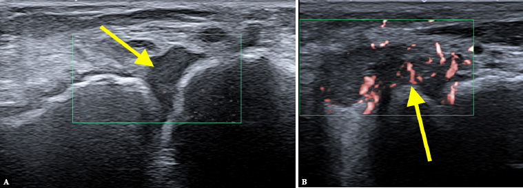 Ultrasound and MRI of the foot in children and adolescents newly diagnosed with juvenile idiopathic arthritis.