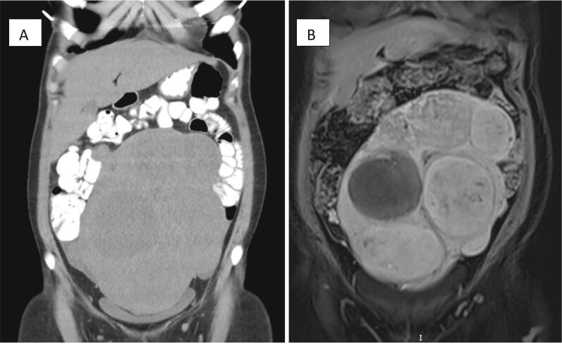 Hereditary leiomyomatosis and renal cell cancer (HLRCC) syndrome in a young patient presenting with a large uterus: A case report and review of the literature