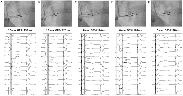 Left ventricular septal pacing – can we trust the ECG?