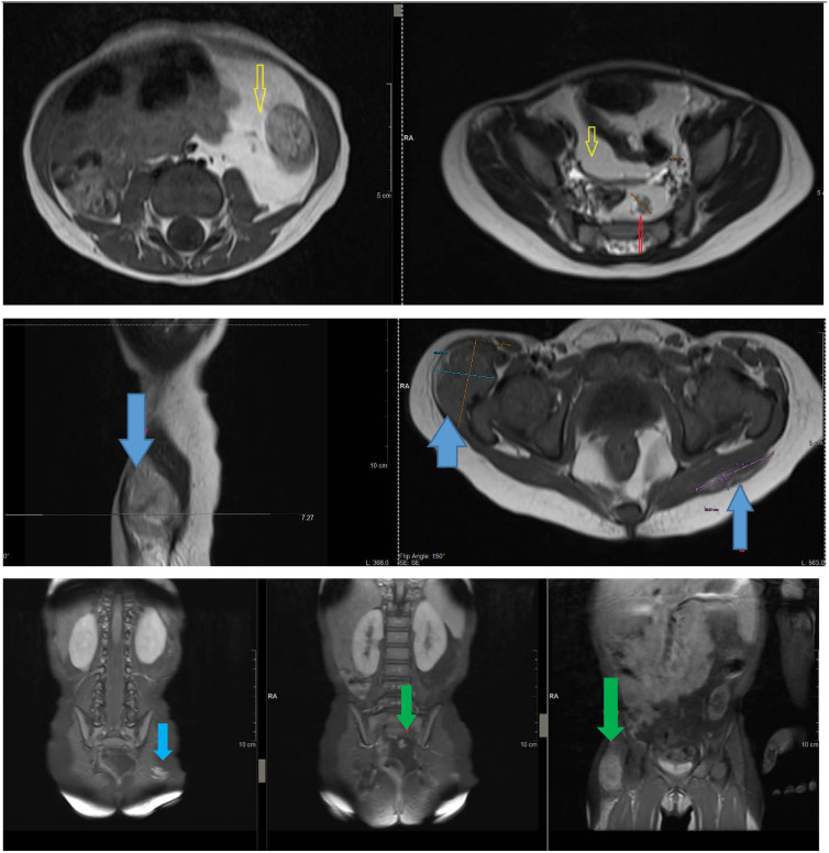 The First Familiar Case of PTEN-Related Disorder Reported in Albania.