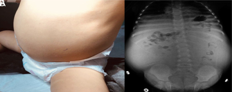 Massive Elevation of CA-125 in Chylous Ascites.