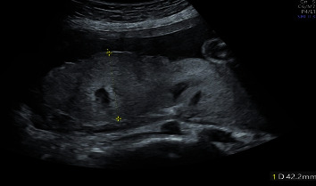 The sFlt-1/PlGF Ratio Trend Is Useful in Predicting Preeclampsia Severity in Hyperreactio Luteinalis Complicated with Preeclampsia.