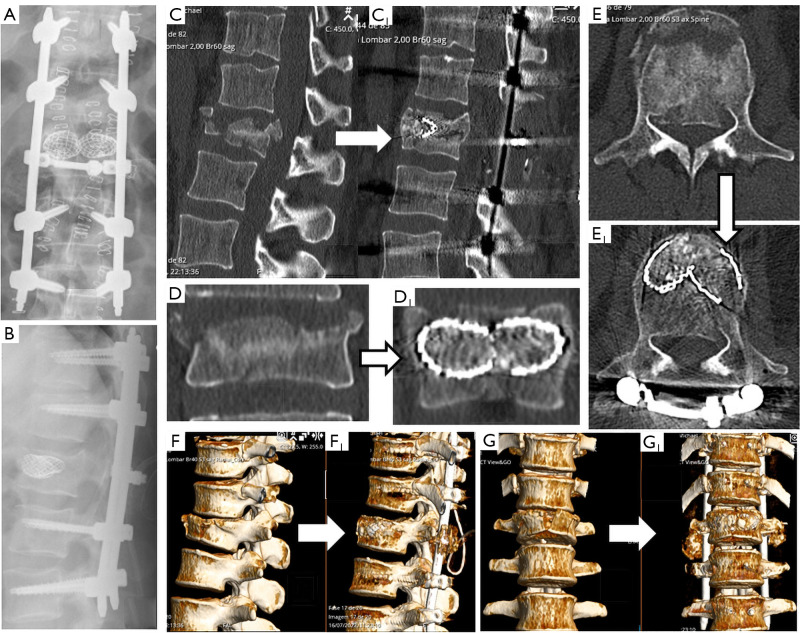 Anatomical reconstruction of complete burst vertebral fracture case report-combined reduction methods and armed kyphoplasty with stents filled with bone graft.