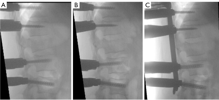 Anatomical reconstruction of complete burst vertebral fracture case report-combined reduction methods and armed kyphoplasty with stents filled with bone graft.