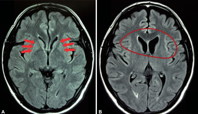 Nine Hereditary Movement Disorders First Described in Asia: Their History and Evolution.