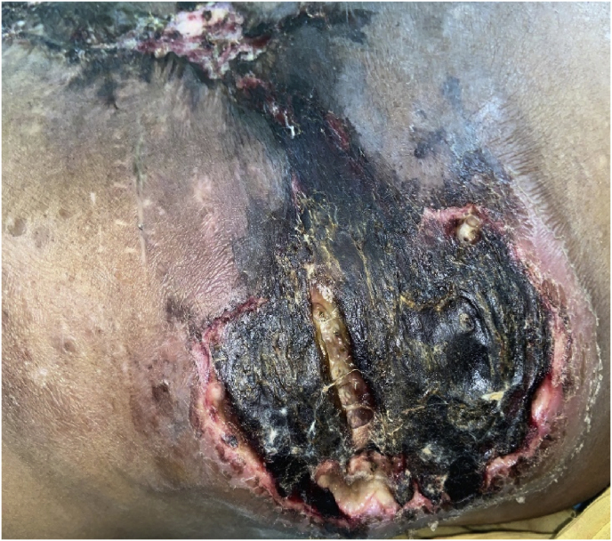 A Psittacine bite and subcutaneous basidiobolomycosis: A case with a therapeutic challenge