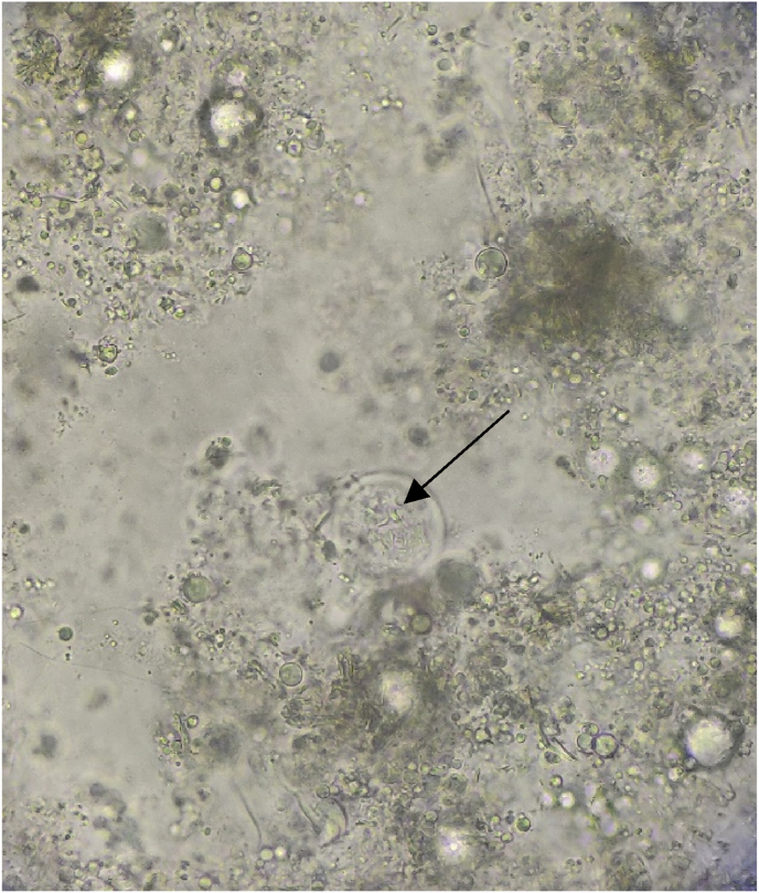 A Psittacine bite and subcutaneous basidiobolomycosis: A case with a therapeutic challenge