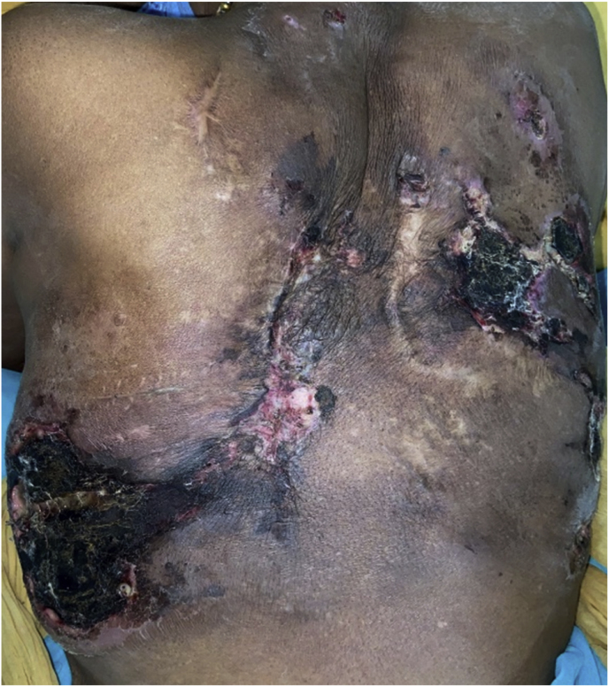 A Psittacine bite and subcutaneous basidiobolomycosis: A case with a therapeutic challenge