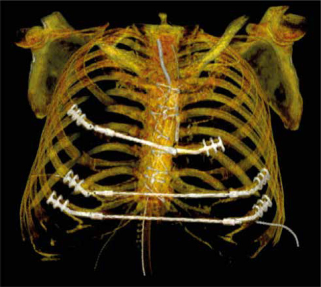 Extensive chest wall stabilization after cardiopulmonary resuscitation and urgent cardiac surgery.